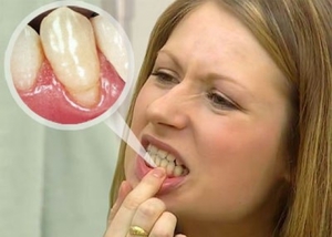 Formazione dei denti - pietre dei denti