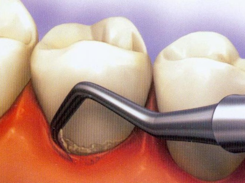 Tartaro e la sua rimozione Calcolo dentale e sue cause