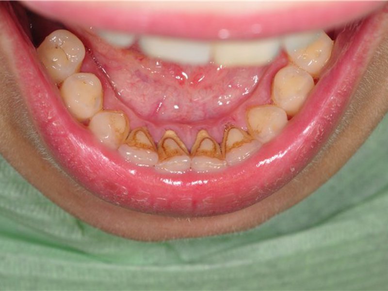 La deposizione di pietre sui denti Prevenzione e cura dei denti