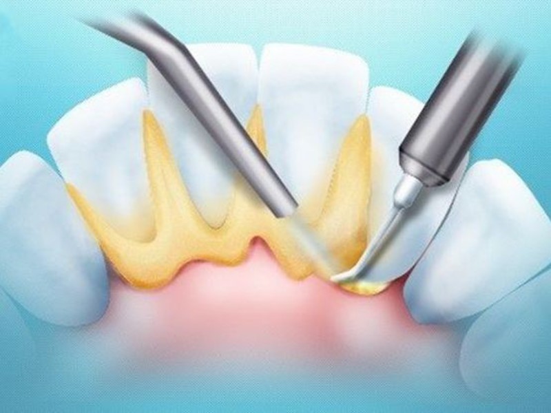 Placca sui denti Formazione della placca sui denti