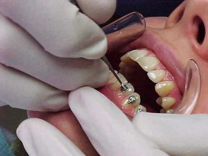 Come funziona il sistema di parentesi graffe