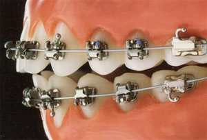 Apparecchi dentali di prezzo