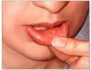 Malattie della mucosa