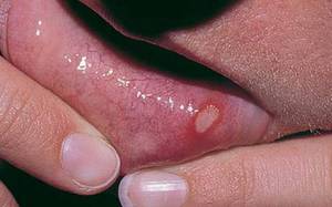 Farmaci per stomatite