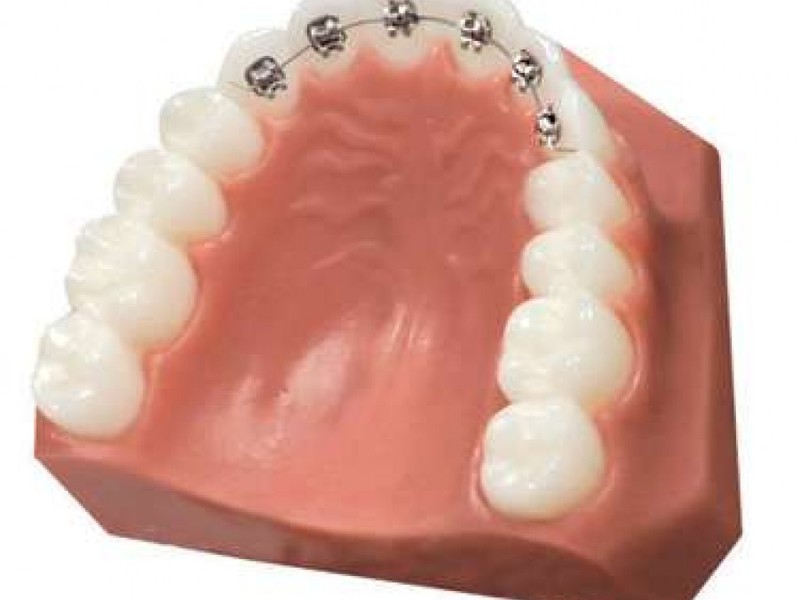 Bretelle linguali sui denti