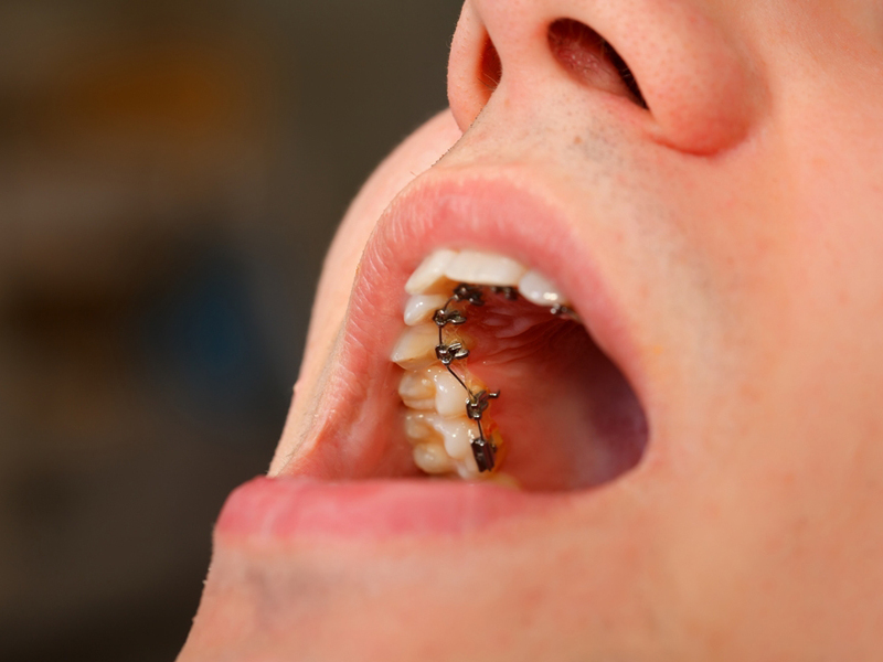 Bretelle linguali sui denti