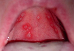 Come trattare la mucosa orale