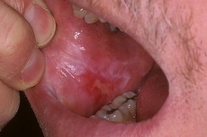 Metodi di trattamento della mucosa orale