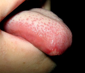 Farmaci nel trattamento della mucosa orale