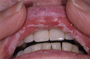 Cosa fare con la malattia della mucosa orale