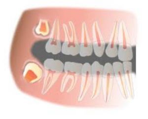 Il dente della saggezza non cura